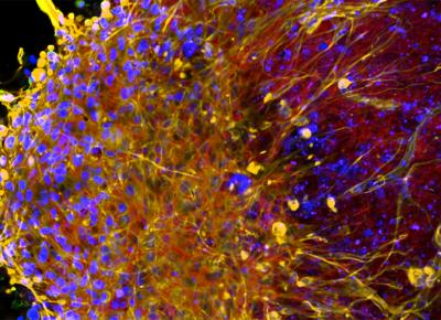 Brain tumor shown in the cortex.
