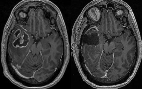Pre- and post-op MRIs of glioblastoma