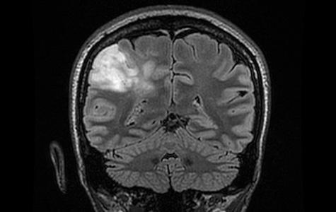 MRI scan of a patient with a low-grade glioma