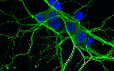 hippocampal neurons co-cultured with glioma cells