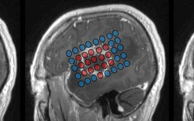 Figure representing the positions of electrodes to record brain activity and map tumors