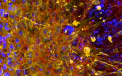 Brain tumor in the cortex