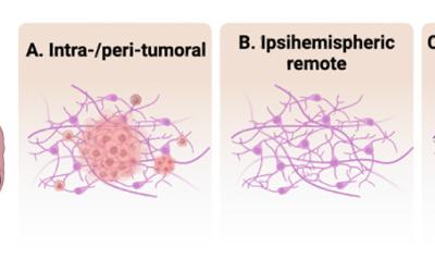 Cartoon illustration showing different regions of the brain stimulated relative to the tumor location.