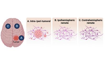 Cartoon illustration showing the different areas of the brain stimulated relative to the position of the tumor